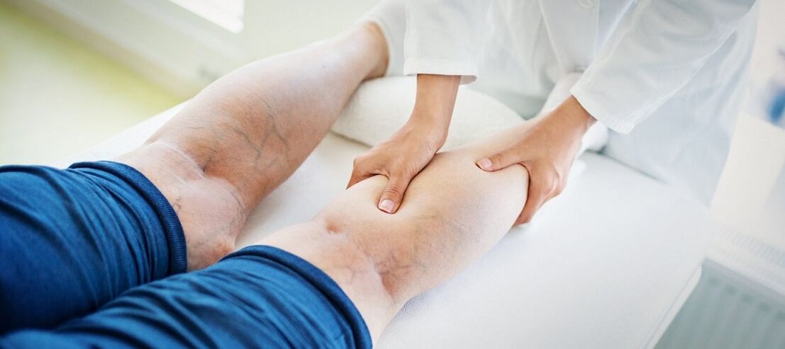 Krampfadern in den Beinen und ihre Behandlung